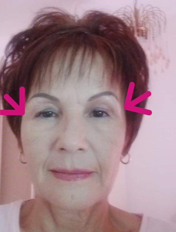 1 week after treatment 2