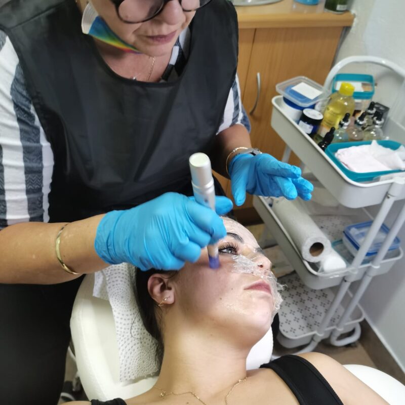 Microneedling