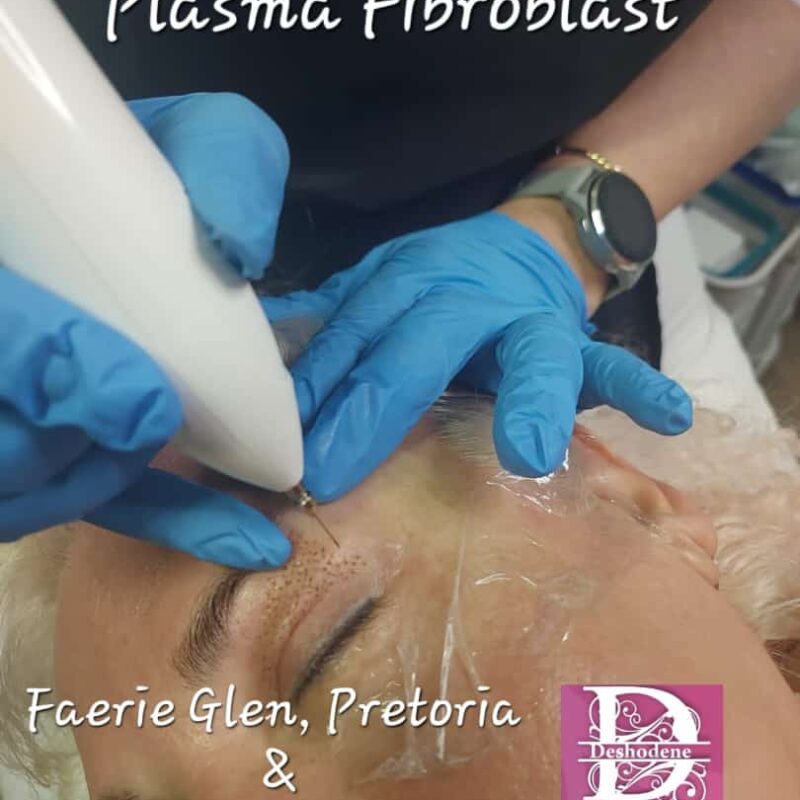 Plasma Fibroblast Upper Eyelids