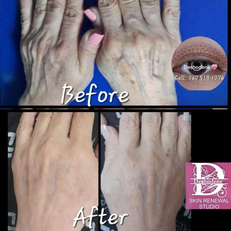 Plasma Fibroblast on hands