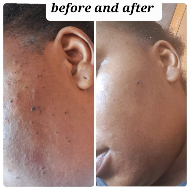 Skin Tag Removal